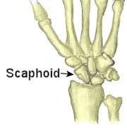 Scaphoid